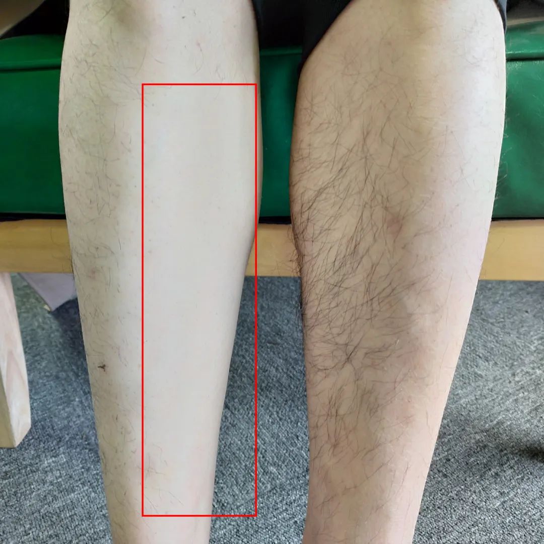 夏季脱毛必备,夏日必备脱毛告别尴尬