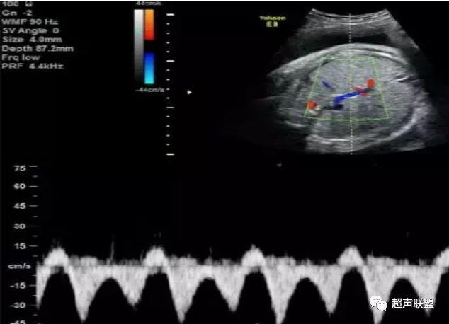 胎儿宫内窘迫如何判断,38周如何判断胎儿宫内窘迫或缺氧