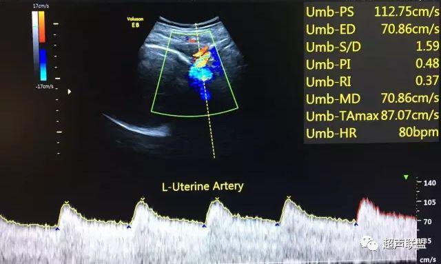 胎儿宫内窘迫如何判断,38周如何判断胎儿宫内窘迫或缺氧