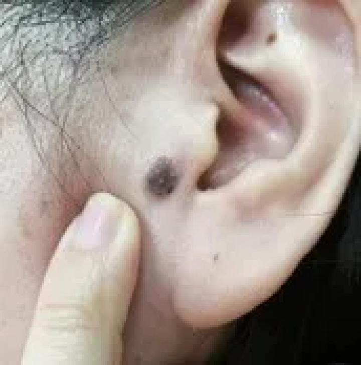 黑痣癌变的痣会很大吗,黑痣癌变一般是一个痣还是好多