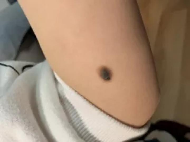 黑痣癌变的痣会很大吗,黑痣癌变一般是一个痣还是好多