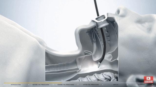 盘点医院各大科室侵入性检查：穿刺、内镜各显神通，小活检标本以“小”见“大”