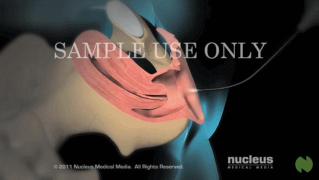 盘点医院各大科室侵入性检查：穿刺、内镜各显神通，小活检标本以“小”见“大”