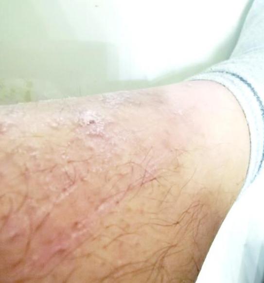 踏青防止蚊虫叮咬温馨提示,踏青被蚊虫咬了怎么办