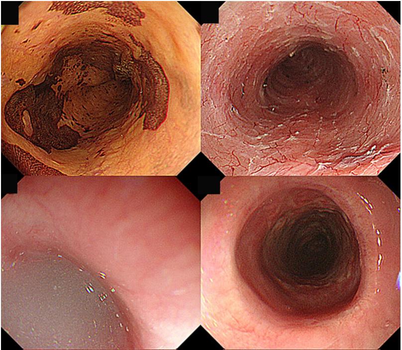 esd术后食管狭窄扩张效果,esd曲安奈德