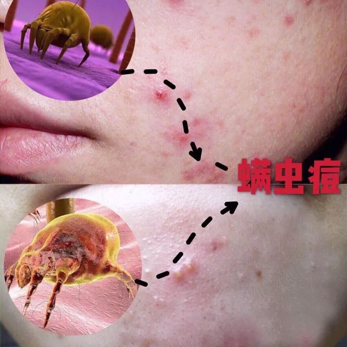 用什么洗脸抑制螨虫生长,用什么洗脸可以抑制螨虫生长