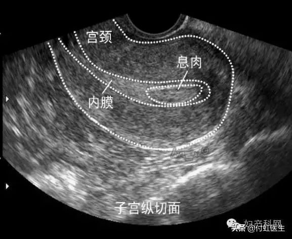 b超检查子宫内膜回声不均,b超检查显示子宫回声不均