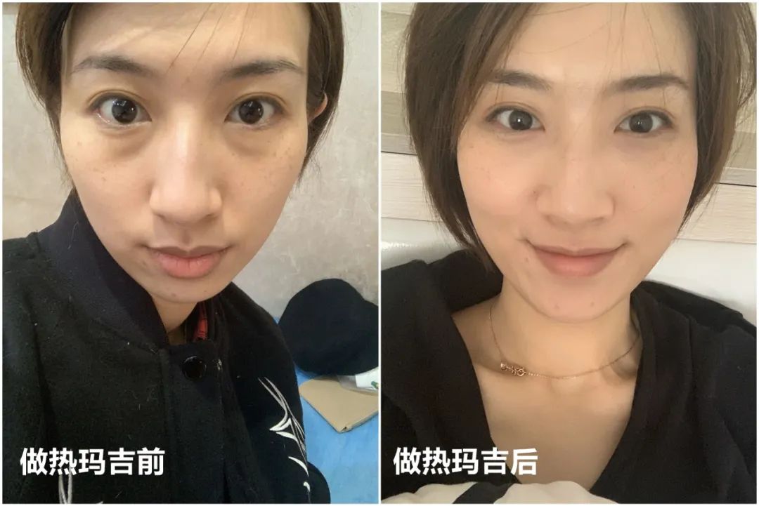 做完医美真的能换脸吗,做完医美需要注意什么