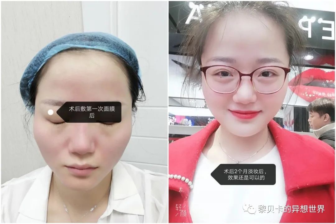 做完医美真的能换脸吗,做完医美需要注意什么