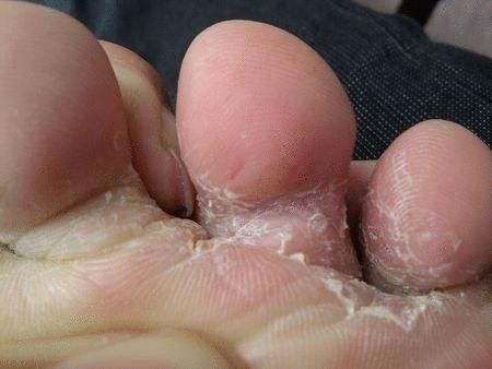 脚臭脱鞋多久可以去味,脚臭喷鞋袜除臭