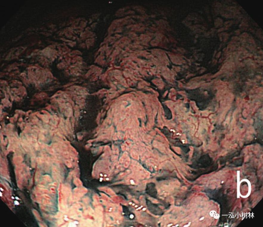 胃高级上皮内瘤变内镜案例,胃局灶性淀粉样变性预后