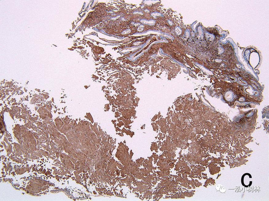 胃高级上皮内瘤变内镜案例,胃局灶性淀粉样变性预后