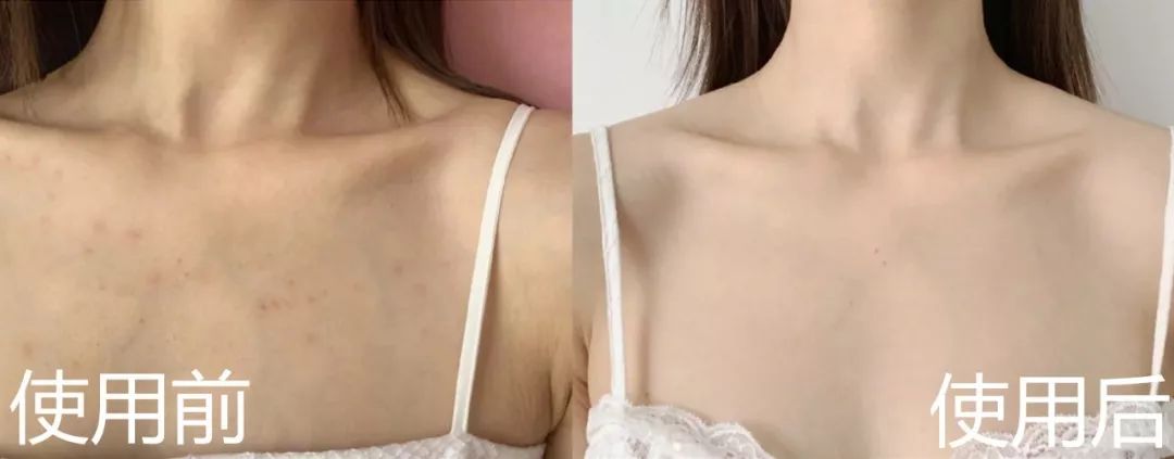 鼻头痘痘挤出来的白色物质是什么,团状红痘痘