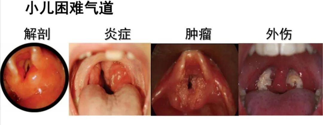 气道异物患者麻醉,小儿气道异物麻醉