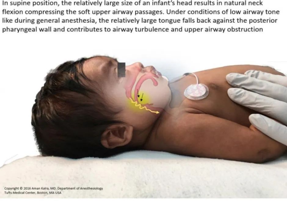 气道异物患者麻醉,小儿气道异物麻醉