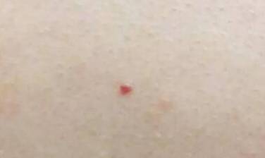 【注意】千万别大意！身上有这种小红痣，很可能是大病的预警信号…