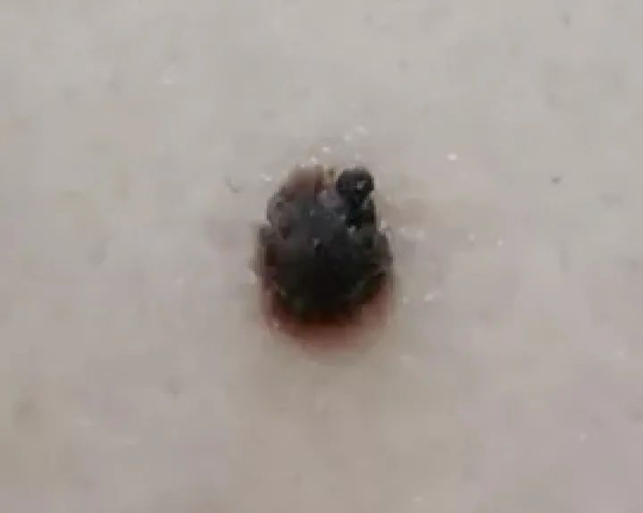 黑痣癌变的痣会很大吗,黑痣癌变一般是一个痣还是好多