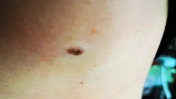 黑痣癌变的痣会很大吗,黑痣癌变一般是一个痣还是好多