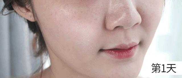 花了3万做激光，才彻底懂了：医生为什么劝你别去斑