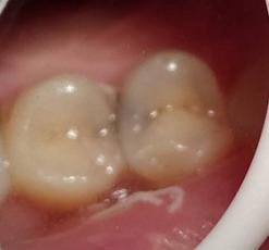 邻面龋可以变成静止龋吗,门牙邻面龋早期怎么处理