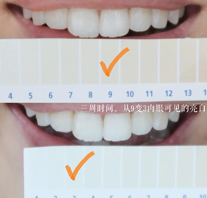 牙齿变黄你真的刷对了吗,牙齿黄了怎么办不用花钱去洗牙