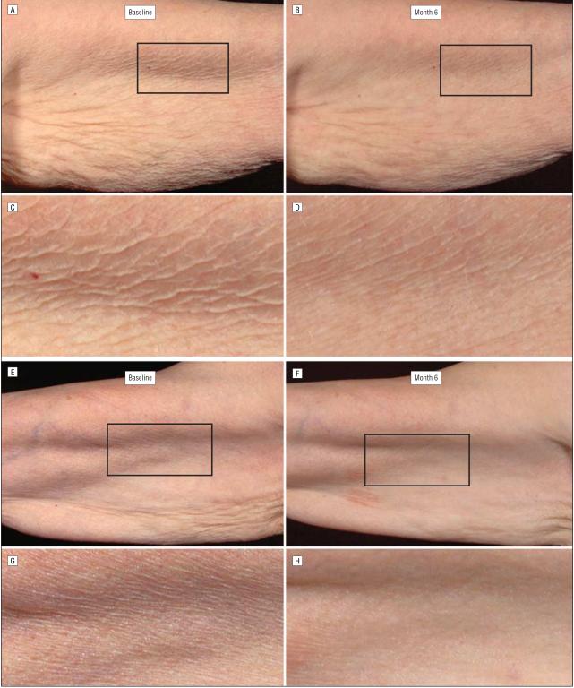 眼角长皱纹了怎么办,长皱纹了怎么办
