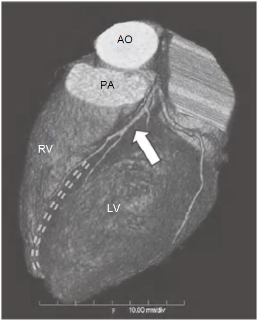 冠脉ct血管示意图的亮点是什么,冠脉血管造影识图
