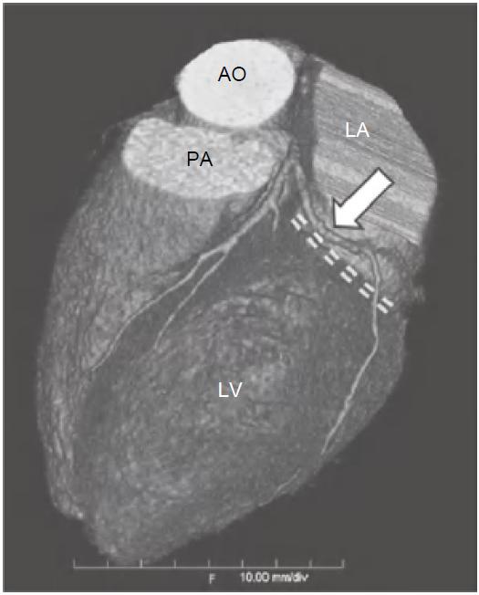 冠脉ct血管示意图的亮点是什么,冠脉血管造影识图
