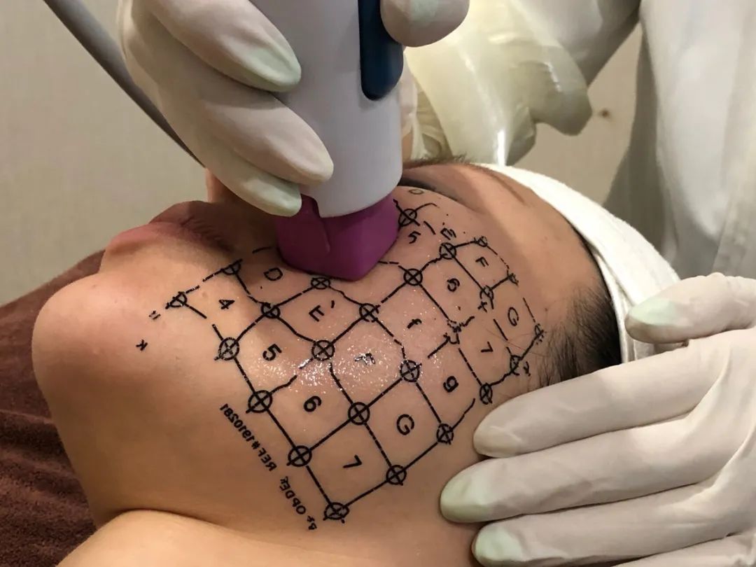 网红热玛吉效果怎么样,5代热玛吉美白