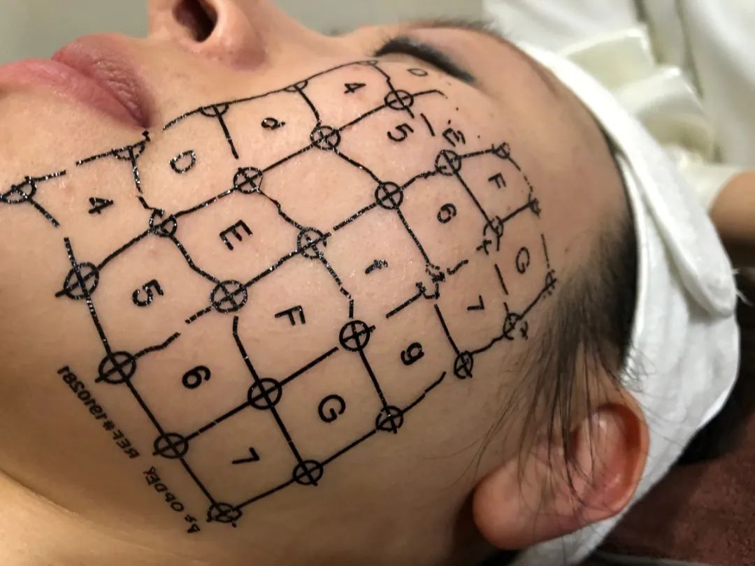 网红热玛吉效果怎么样,5代热玛吉美白