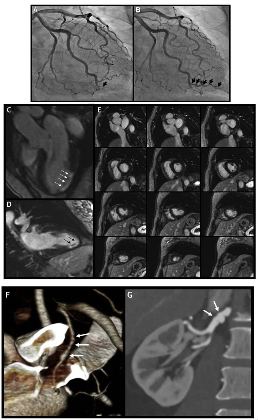 冠状动脉夹层症状和治疗,自发性冠状动脉夹层斑块破裂