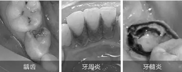 牙齿酸用抗敏感牙膏有效,抗牙本质敏感牙膏