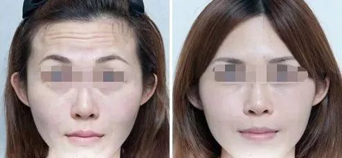 抬头纹眉间纹怎么去除,眉间纹抬头纹去除最好的方法