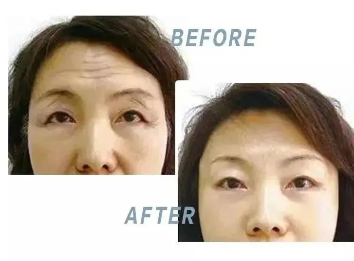抬头纹眉间纹怎么去除,眉间纹抬头纹去除最好的方法