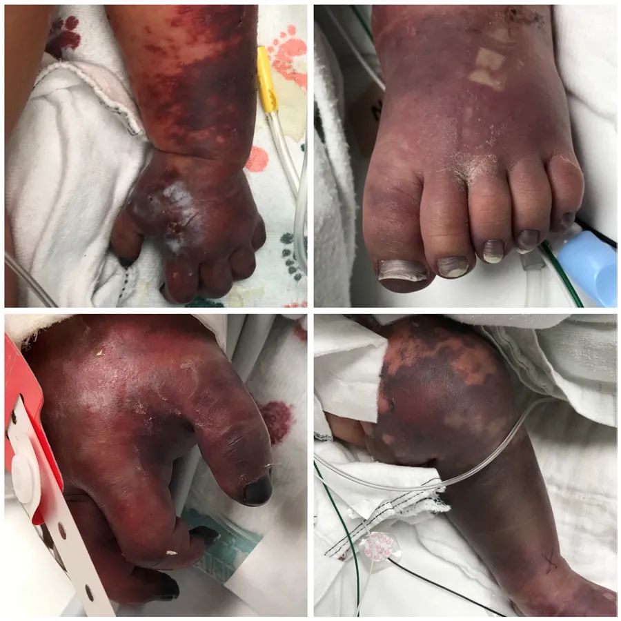 暴发性紫癜是什么原因引起的,暴发性紫癜是怎么回事