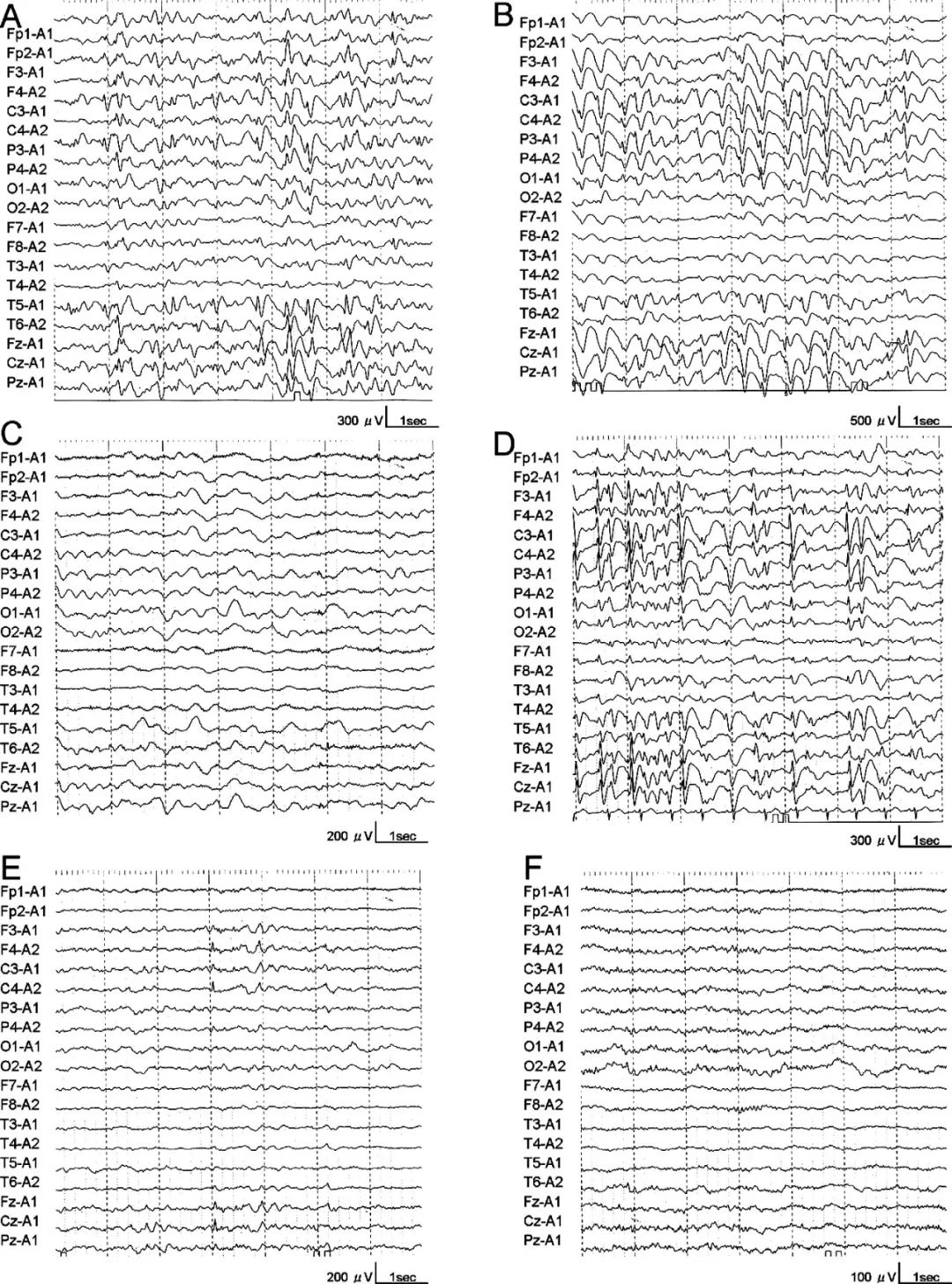 婴儿痉挛症打acth后发作增多,acth治疗哪种痉挛