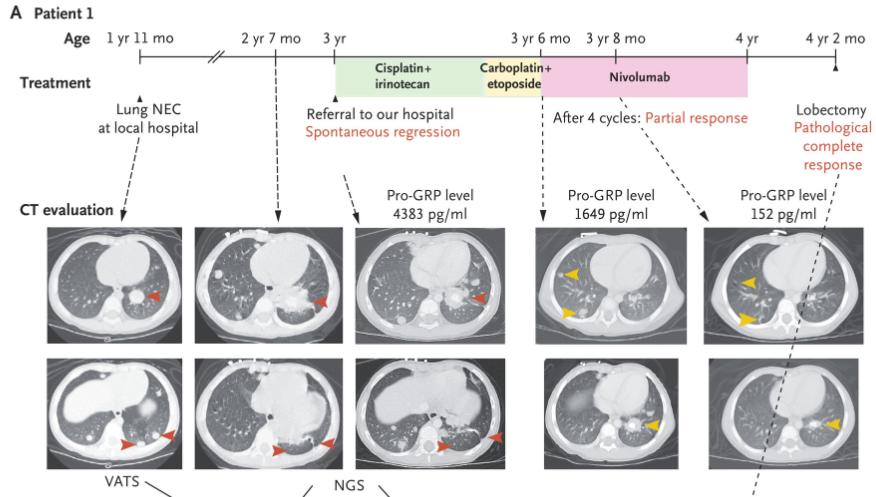 NEJM：宫颈癌细胞竟能经产道进入婴儿的肺！科学家首次发现宫颈癌母亲顺产导致儿子患肺癌的案例，母子肿瘤基因谱高度吻合丨临床大发现