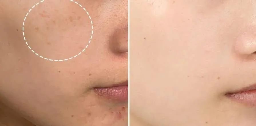 花了3万做激光，才彻底懂了：医生为什么劝你别去斑