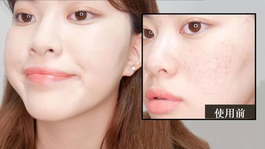 花了3万做激光，才彻底懂了：医生为什么劝你别去斑