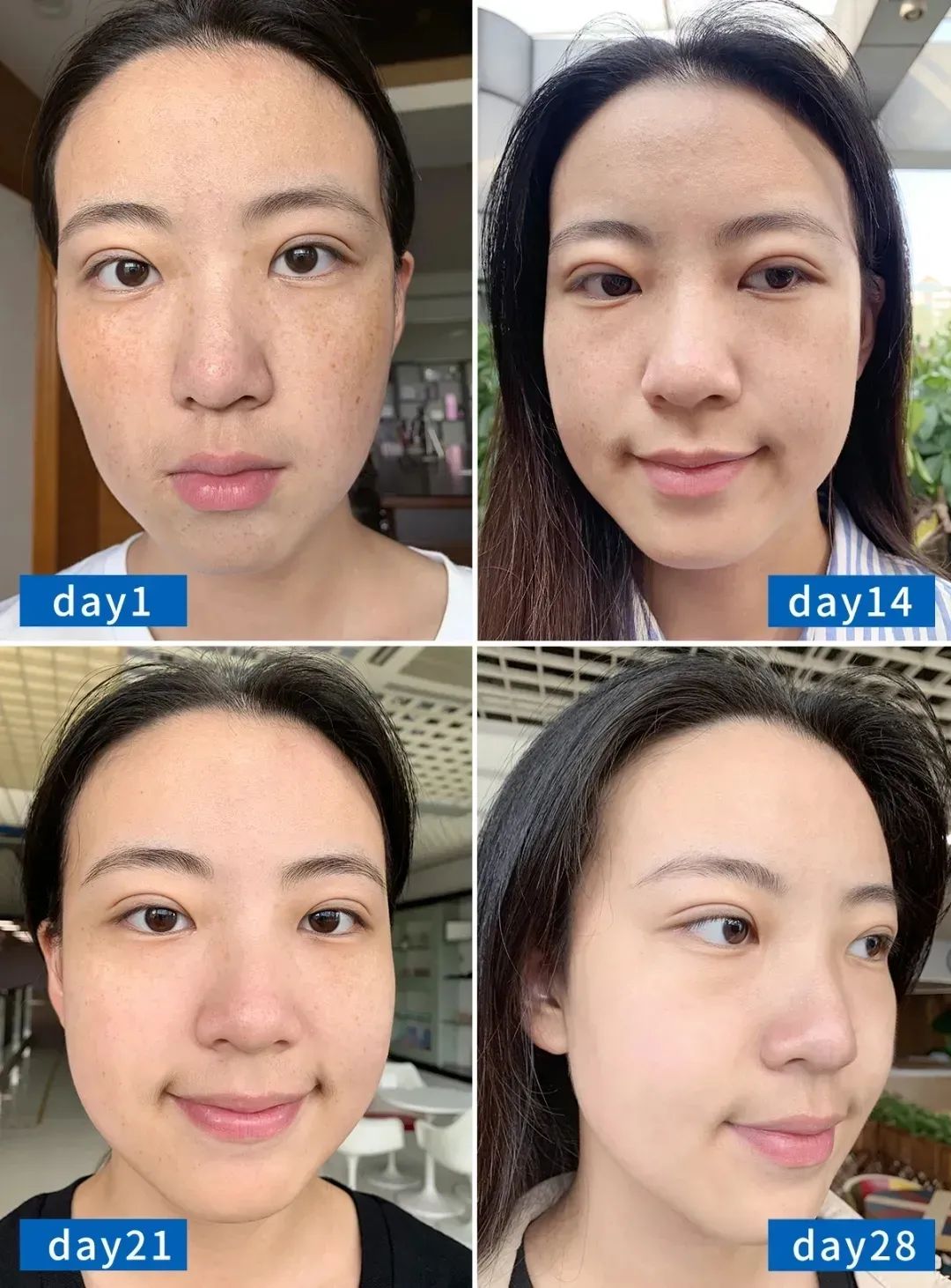 花了3万做激光，才彻底懂了：医生为什么劝你别去斑