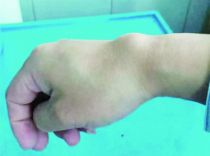 腱鞘囊肿有长在胳膊前臂外侧的吗,腱鞘囊肿好发于什么部位