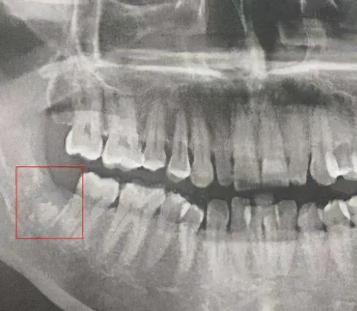 拔牙过后一直麻是对的吗,拔牙之后一直疼