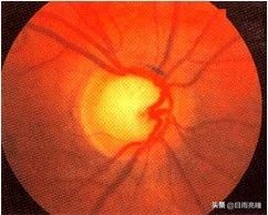 眼压异常的症状,眼压偶尔偏高一点有问题没