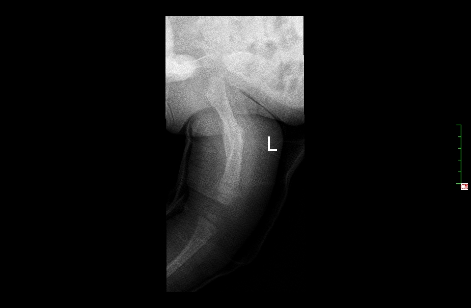 幼儿骨折误区,儿童骨折为什么好得快