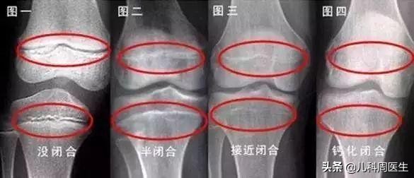 谁说“春生夏长”专指植物？医生：做到这些且能让你拥有理想身高