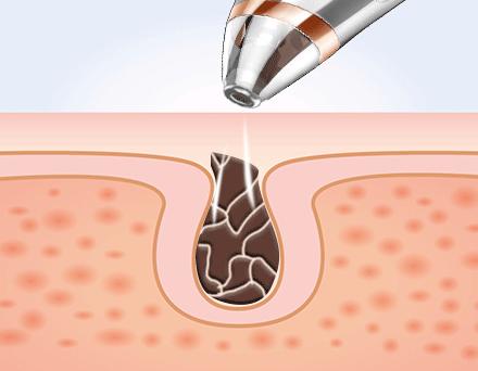 黑头怎么去除简单方法学生,十滴水去除黑头的方法
