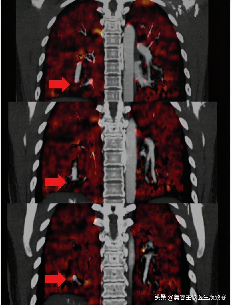 私密整形严重并发症：阴道注射填充剂9小时后永久停止呼吸