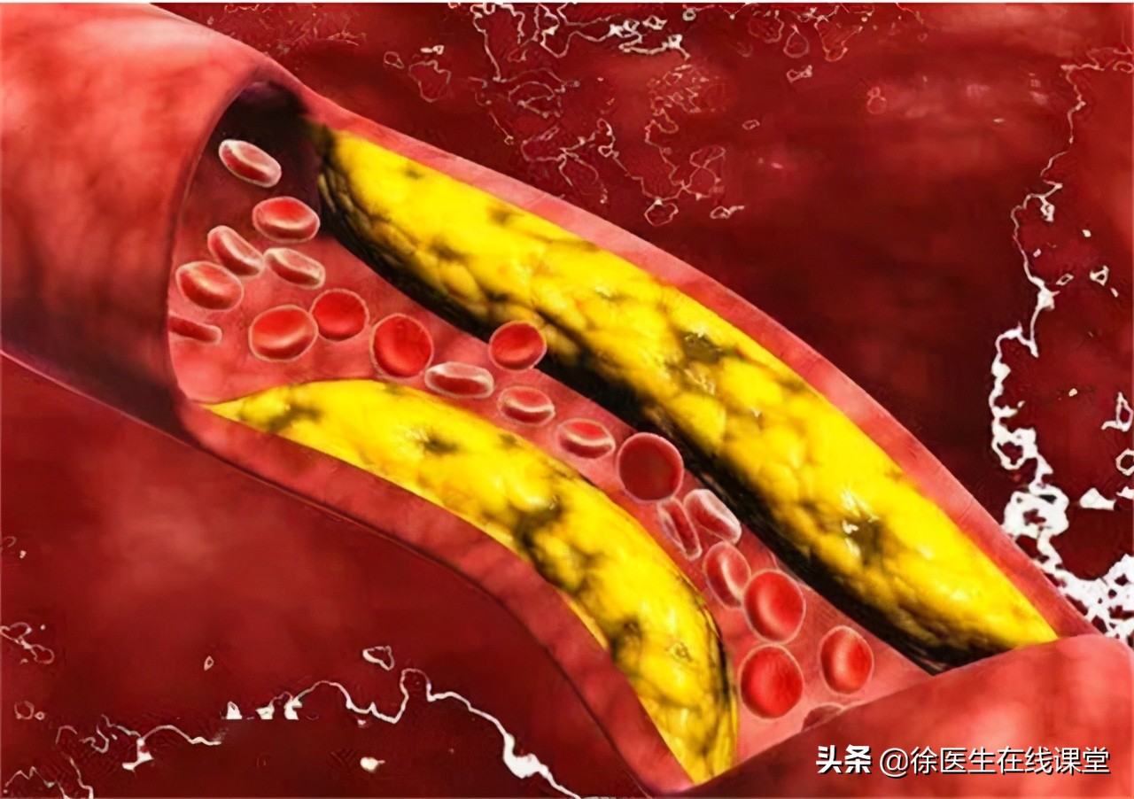 胆固醇6.6血脂3.06需要吃药吗,胆固醇跟血脂多少才需要吃药
