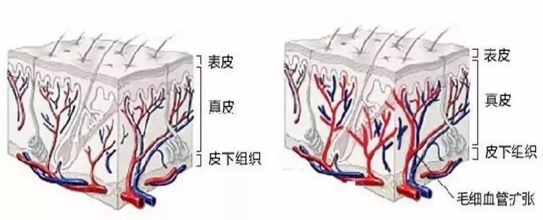 这5个方法让你轻松搞定红血丝,潮红性红血丝怎么修复