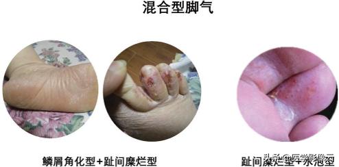 足部扁平苔藓,足癣病例